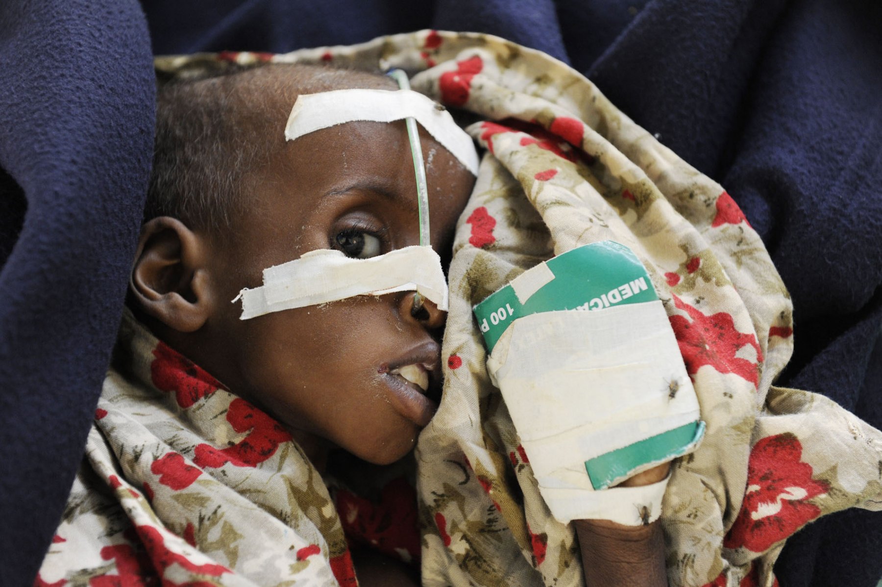 A severely malnourished Somalian baby is being treated in a field hospital at a refugee camp in Dadaab, northeastern Kenya Wednesday, August 3, 2011. Somalia and parts of Kenya have been struck by one of the worst droughts and famines in six decades, more than 350.000 refugees have found shelter in the worlds biggest refugee camp. Photo: Boris Roessler dpa  +++(c) dpa - Bildfunk+++