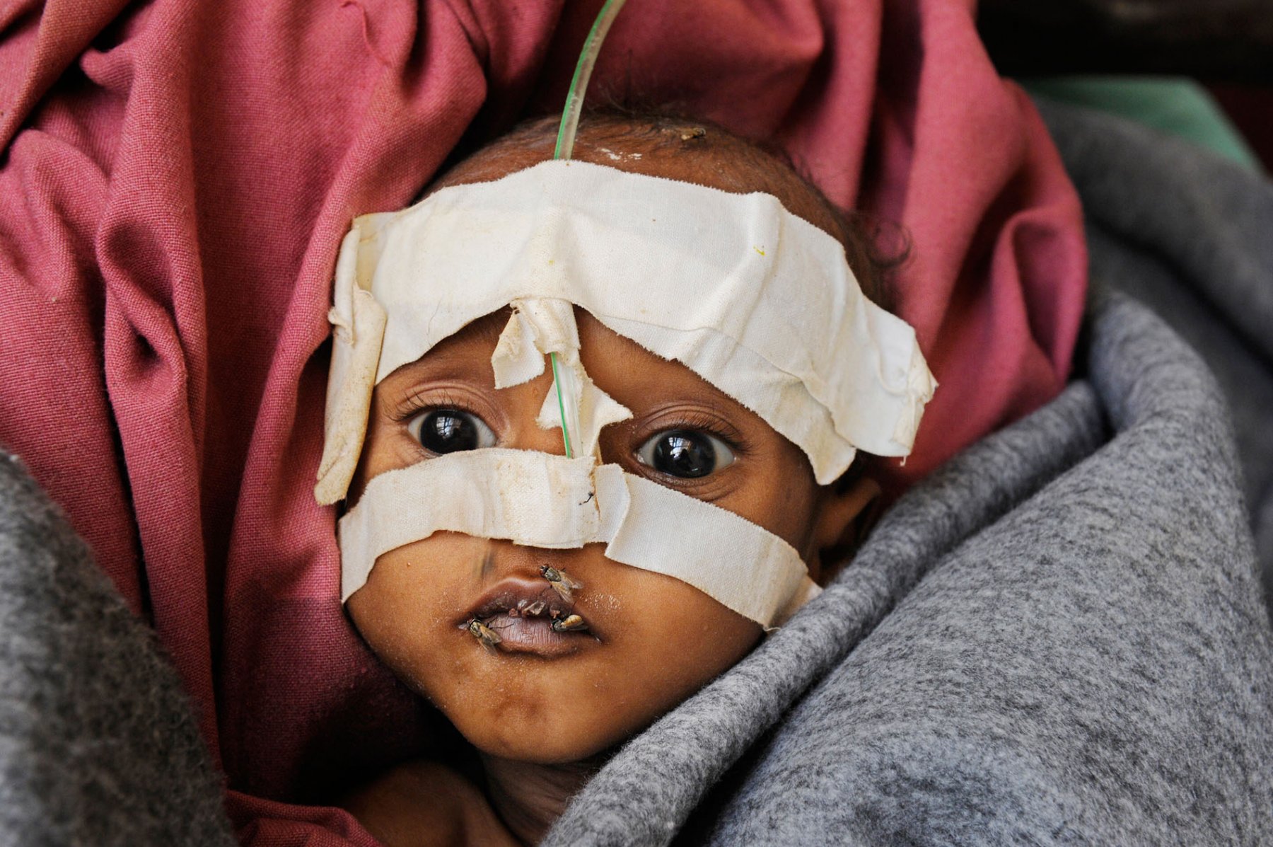 A massively malnourished somalian baby is being treated in a field hospital at a refugee camp in Dadaab, northeastern Kenya on wednesday, August 3rd 2011. Somalia and parts of Kenya have been struck by one of the worst droughts and famines in six decades, more than 350.000 refugees have found shelter in the worlds biggest refugee camp. Foto: Boris Roessler dpa